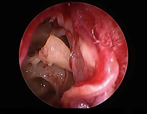 Ossiculoplasty Middle Ear Surgery In Iran Medpersia Medical Tourism