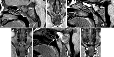 Sphenoid Sinus Development On Mri A F Appearance Of The Clivus In A