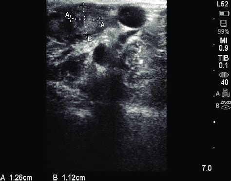 Ultrasound image of first corpus luteum (12.6×11.2 mm) which appears ...