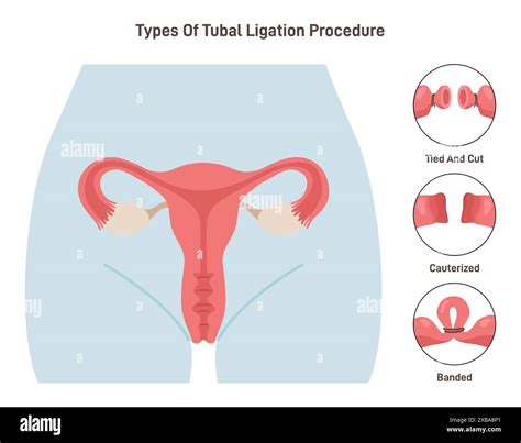 Tubal Ligation Surgery Permanent Birth Control Procedure Types Tubes