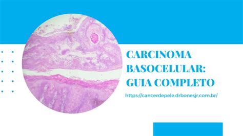 Carcinoma Basocelular Especialista Em Câncer De Pele