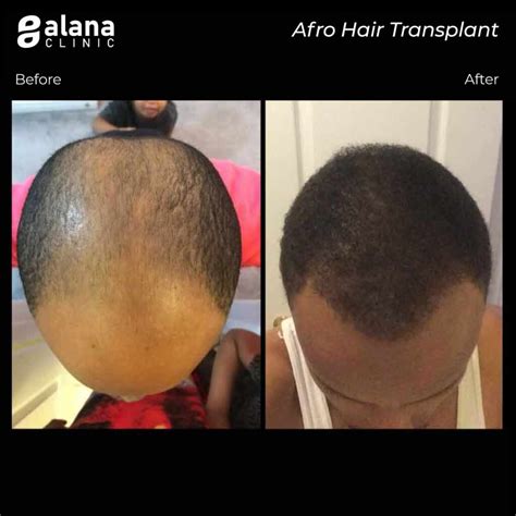 Afro Hair Transplant Turkey Alana Hair Clinic