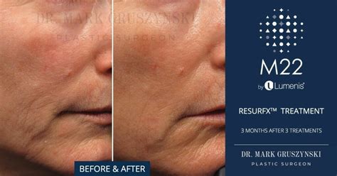 Laser Treatments With Lumenis Stellar M Dr Mark Plastic Surgery