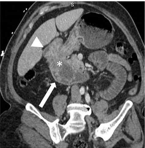 Figure 3 From Gastroduodenal Intussusception Intermittent Biliary Obstruction And Biochemical