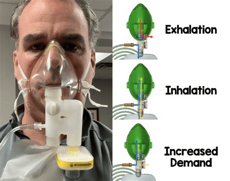 COVID-19: Airway Management - REBEL EM - Emergency Medicine Blog