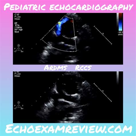 Ultrasound Board Review Modified Blalock Taussig Shunt