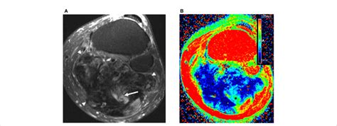 57 year old man with large calf mass. (A) Axial fat suppressed ...