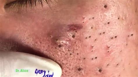 Newest Blackhead Removal Videos 2024 Youtube Eula Laurella