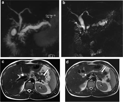 Chronic Pancreatitis Ercp