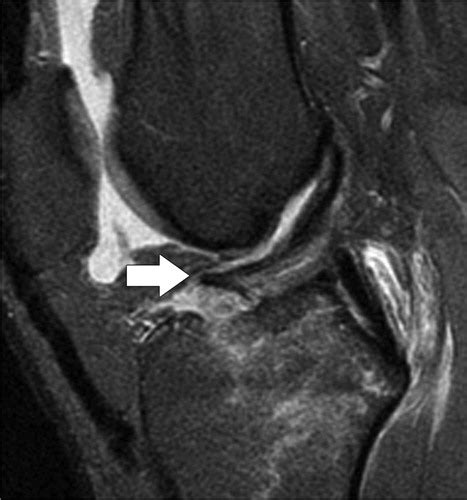 Tibial Plateau Fracture Mri