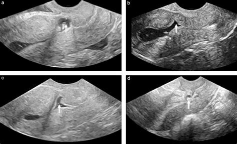 Ultrasound Evaluation Of The Cesarean Scar Relation Between A Niche