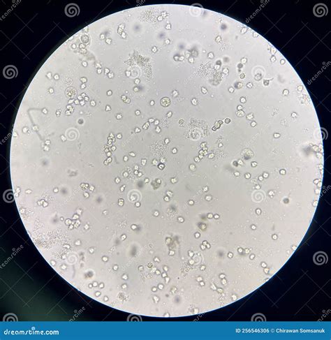 Moderate Bacteria and White Blood Cells in Urine Stock Photo - Image of ...