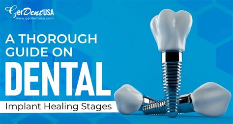 Dental Implant Healing Stages What To Expect During The Recovery