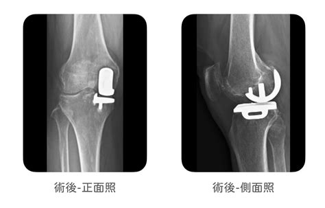 半膝關節置換手術：半膝？全膝？膝關節磨損不用全換更微創？｜蔡尚聞醫師