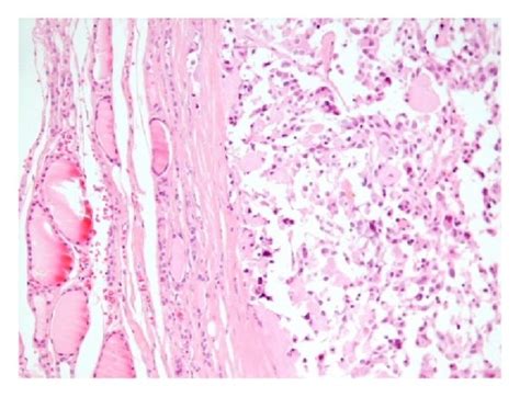 Medullary Carcinoma H E Nests Or Chords Of Cells Penetrating Dense