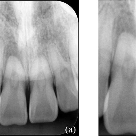 Pdf Microscopic Endodontics In Infected Root Canal With Calcified Structure A Case Report