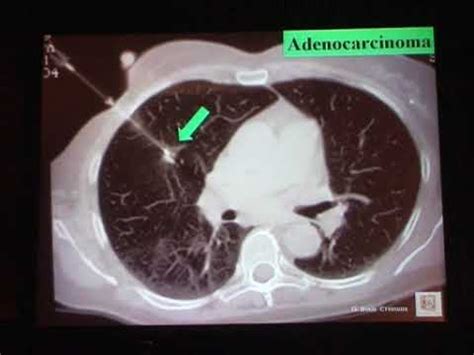 15 Neoplasie Del Polmone Le Biopsie Polmonari Giancarlo Bosio YouTube