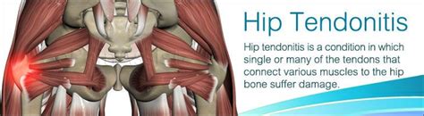 Hip Tendonitis | Tendonitis causes, Hip injuries, Hip workout