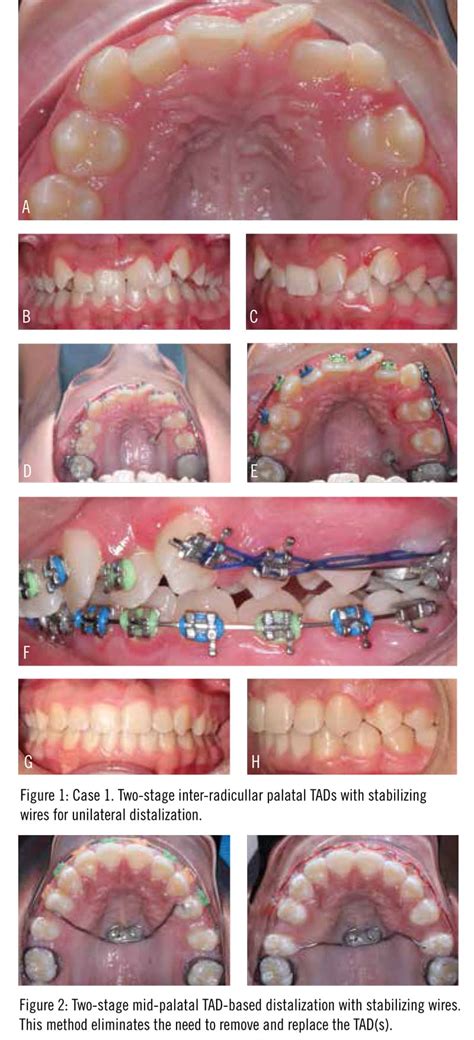 Maxillary Distalization With Tads Orthodontic Products