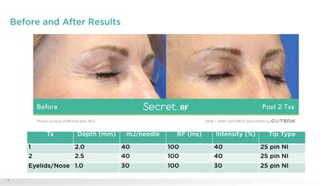 Secret Rf Micro Needling