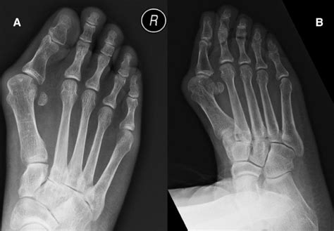 Endoscopic Curettage And Bone Grafting Of Intraosseous Ganglion Of The