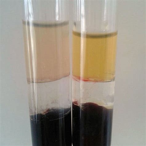 Medical Laboratory and Biomedical Science: Low Blood Bicarbonate Linked to Earlier Death in ...