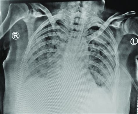 Chest X-ray findings confirmed | Download Scientific Diagram