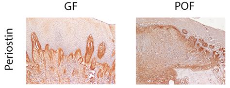 Periostin Stain Distribution In Gingival Fibromas A And Peripheral