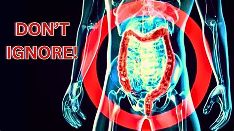 Dont Ignore These 6 Early Warning Signs Of Colon Cancer Youtube