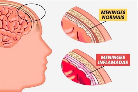 Meningite Meningoc Cica O Que Sintomas Causas E Tratamento Tua Sa De