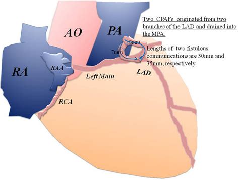 Frontiers Case Report Conquer A Complex Variant Coronary Pulmonary