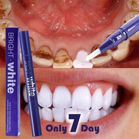 Teeth Whitening Pen Cepat Berkesan Selamat Digunakan Pemutih Gigi