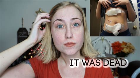 My Gallbladder Removal Surgery And Full Week Of Recovery Youtube