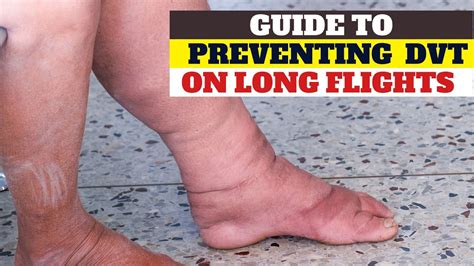 Preventing Deep Vein Thrombosis On A Long Flight Tips For Preventing