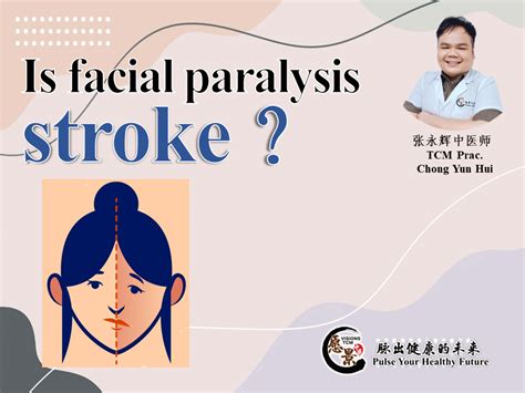 Is facial paralysis stroke? - 愿景中医 Visions TCM