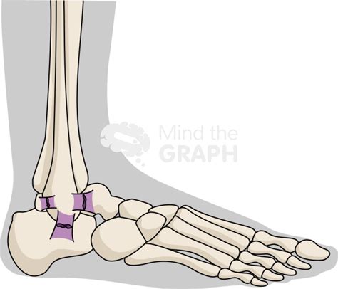 Ankle sprain lateral body