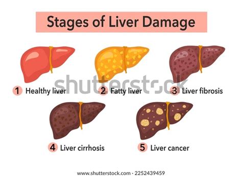 Stages Of Liver Damage Infographic Royalty Free Vector Image Nbkomputer