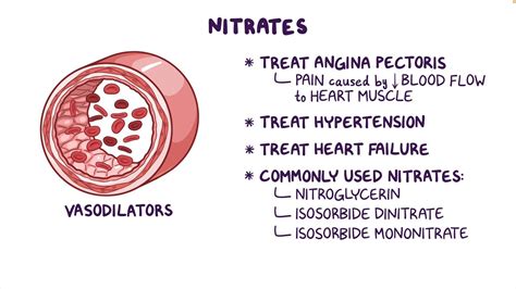 Nitrate Therapy - Osmosis Video Library