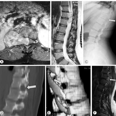 A Axial T2 Weighted Magnetic Resonance Imaging Mri Scan Of The