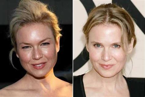 Celebrity Blepharoplasty Before And After 10 Celebrities That Have Had