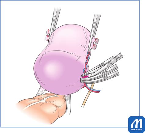 Cutting And Suture Ligation Of The Uterine Artery And Vein The