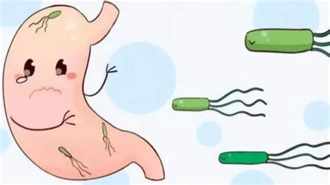 感染了幽門螺旋桿菌會發生胃癌嗎？身體出現這3個現象，要小心 每日頭條