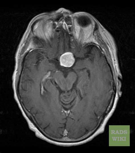 Pituitary adenoma MRI - wikidoc