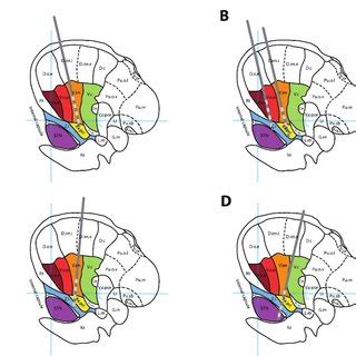 PDF Deep Brain Stimulation For Essential Tremor And Other Tremor