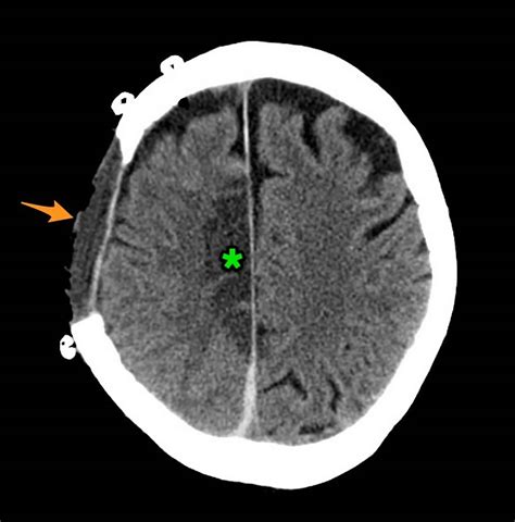 Midline shift brain causes, symptoms, diagnosis & treatment