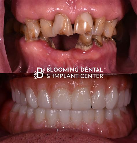 Before & After Photos | Blooming Dental & Implant Center | West ...