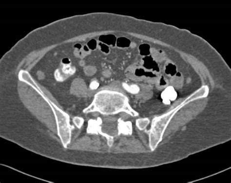 Metastatic Melanoma With Widespread Metastases Including Liver Small