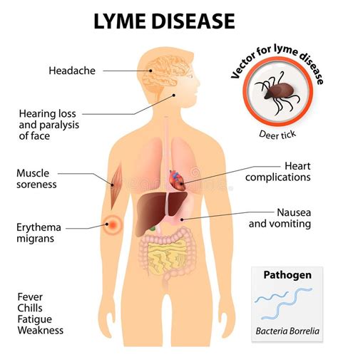 Lyme Disease Or Lyme Borreliosis Stock Vector Illustration Of Human Internal 56327831