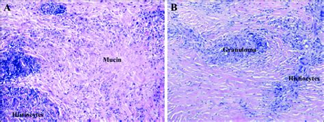 A) Granuloma annulare in high power: epithelioid histiocytes around... | Download Scientific Diagram