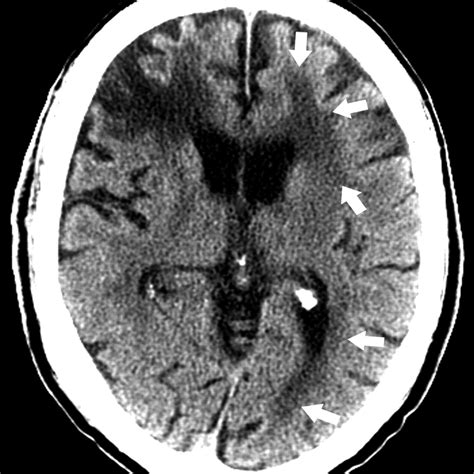 Imaging Of Stroke Part Perfusion Ct Overview Of Imaging Technique